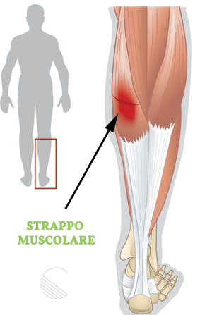 Strappo Muscolare